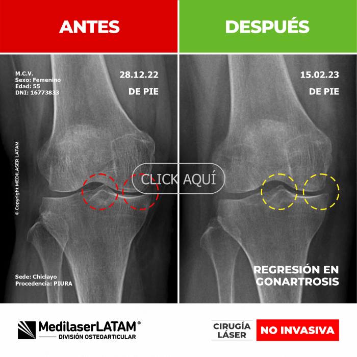 Evidencia en Gonartrosis Izquierda – Maritza Castro Estudio imagenológico evidencia mejoría en artrosis severa de rodilla izquierda.