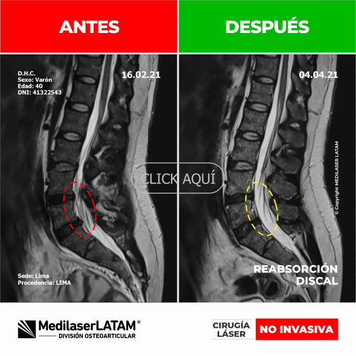 Evidencia de Reabsorción Discal – David Honores Video caso muestra reparación espontánea de hernia discal L4-L5.