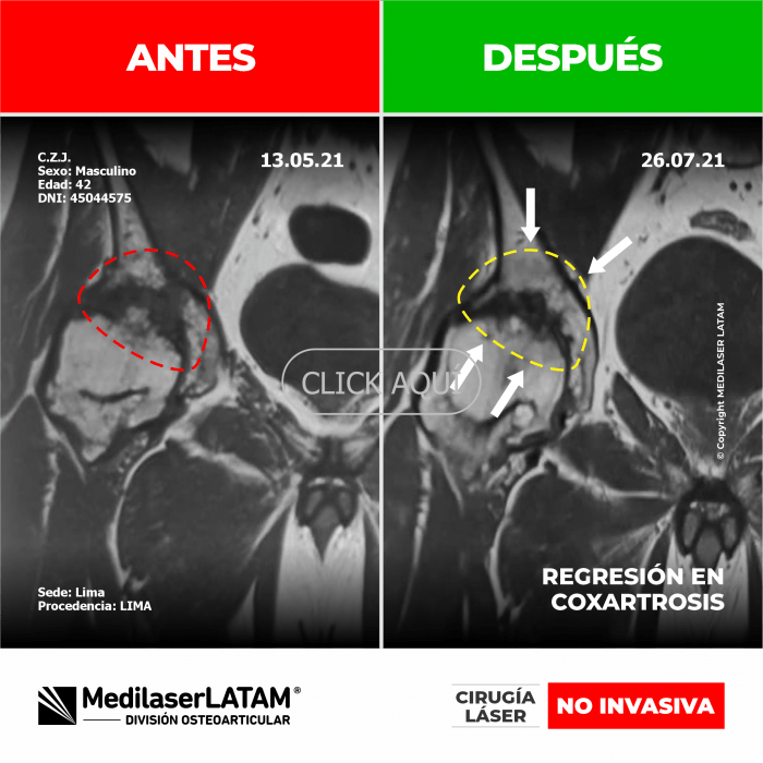Evidencia de Regresión Coxartrosis – José Cruz Documentación con imágenes 3D muestra mejoría estructural en cadera derecha.