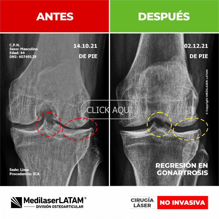Evidencia de Regresión Gonartrosis – Christian Palacios Secuencia radiológica evidencia reversión de artrosis en rodilla derecha.