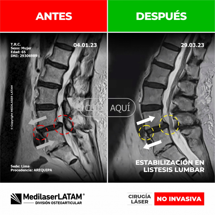 Evidencia en Listesis Lumbar – Teodora Rodríguez Estudio dinámico muestra estabilización de vértebras en espondilolistesis grado I.