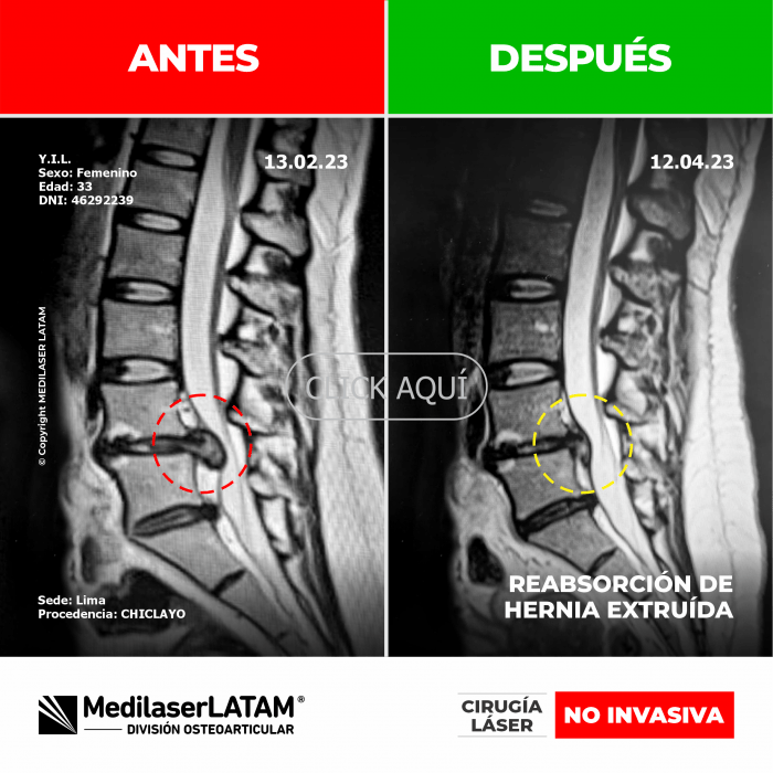 Evidencia de Reabsorción Hernial – Yesenia Inga Resonancia que prueba reabsorción completa de hernia discal extruída L5-S1.