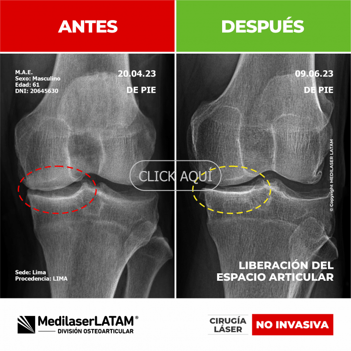 Evidencia de Liberación Articular – Máximo Amaro Video testimonio que muestra ampliación del espacio intervertebral con mejoría clínica comprobada.