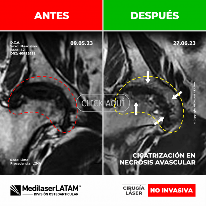 Evidencia en Necrosis Avascular – Dinaldo Campos Documentación radiológica que comprueba regeneración ósea en necrosis de cadera.