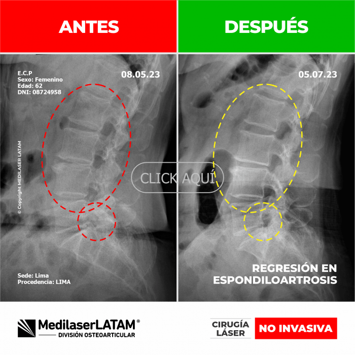 Evidencia en Espondiloartrosis – Editha Cortez Video caso con pruebas de mejoría en columna degenerativa severa.