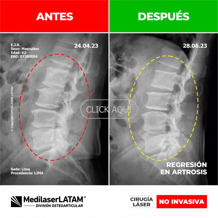 Evidencia de Regresión Artrosis – Enrique Jurado Estudio de 12 meses que demuestra reversión de degeneración articular.