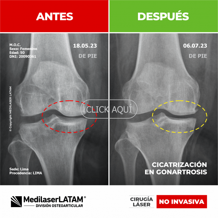 Evidencia en Gonartrosis Izquierda – Mery Osorio Radiografías comparativas que prueban reparación en rodilla izquierda.
