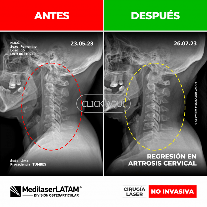 Evidencia en Regresión Cervical – Nury Aguayo Estudio radiológico que muestra reversión de artrosis C5-C6. Antes/después.