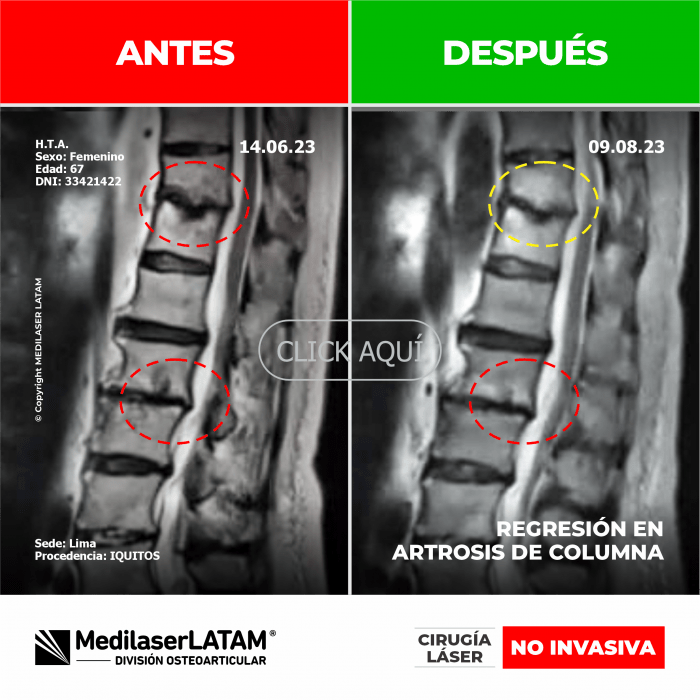Evidencia en Regresión de Artrosis Espinal – Hugo Tenorio Documental médico que comprueba mejoría en columna degenerativa.