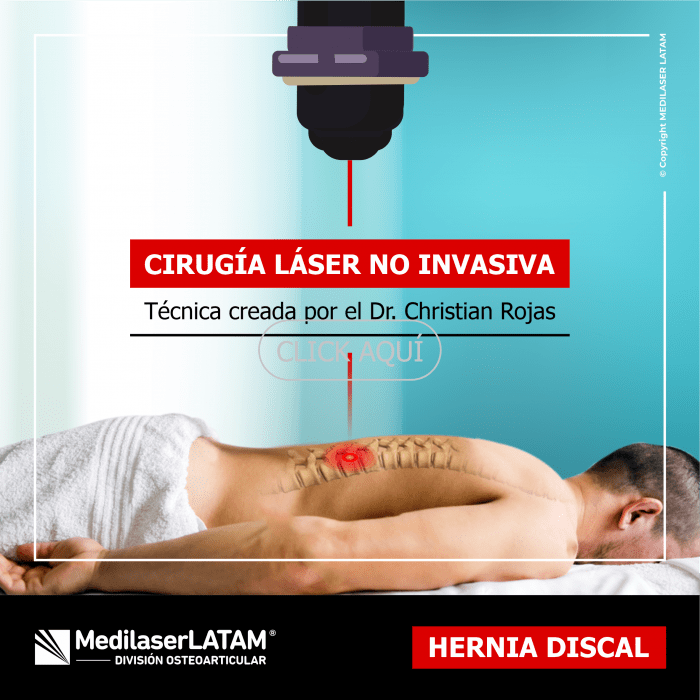 Hernia discal: técnica láser no invasiva que descomprime nervios y frena el deterioro sin cirugía ni hospitalización.
