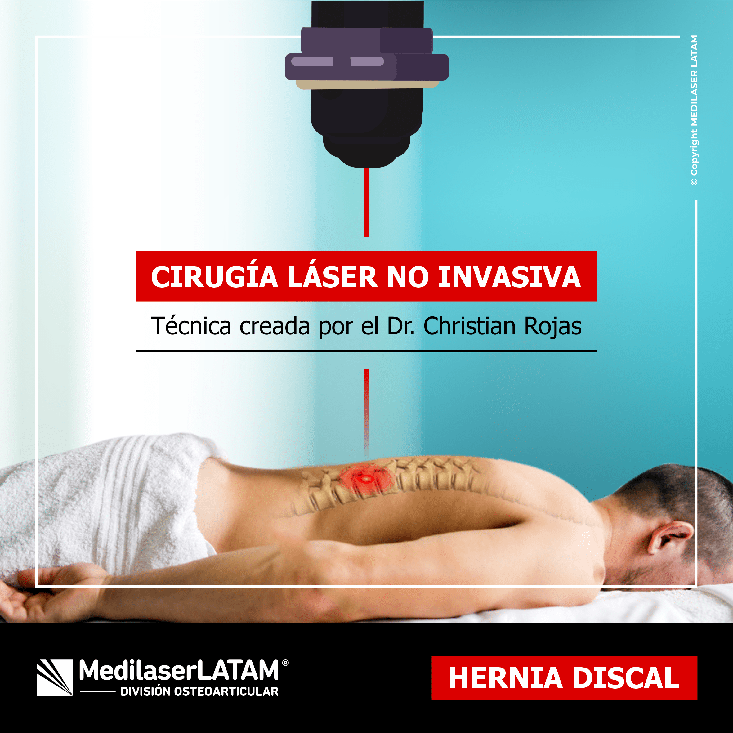 Hernia discal: técnica láser no invasiva que descomprime nervios y frena el deterioro sin cirugía ni hospitalización.