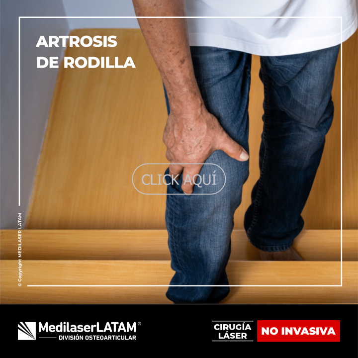 Artrosis de rodilla: tratamiento láser para frenar desgaste y aliviar dolor. Alternativa a cirugía. Alta efectividad.