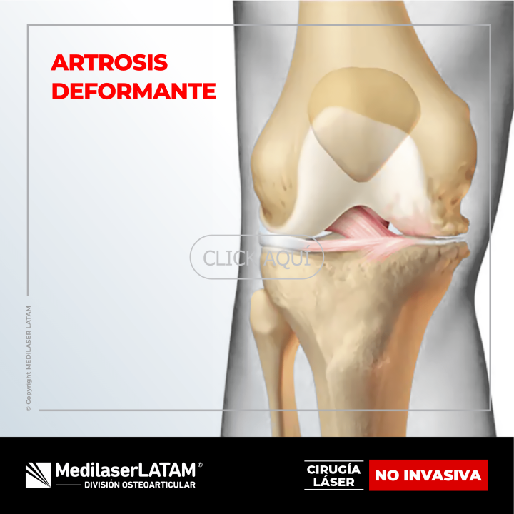 Artrosis deformante de rodilla: tratamiento láser para reducir dolor y deformidad. 88% de efectividad comprobada.