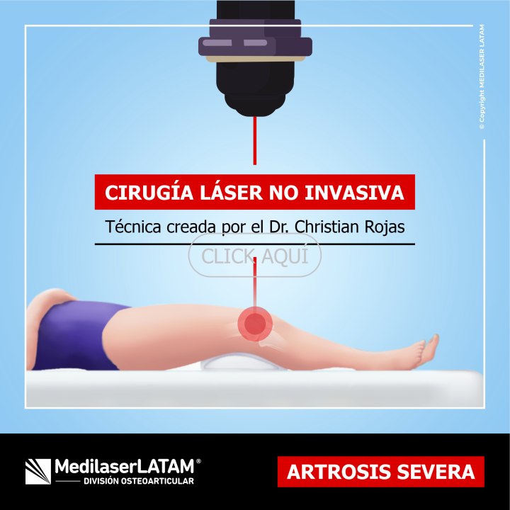 Artrosis severa de rodilla: tratamiento láser para grados 3-4. 90% de efectividad. Alternativa a prótesis.