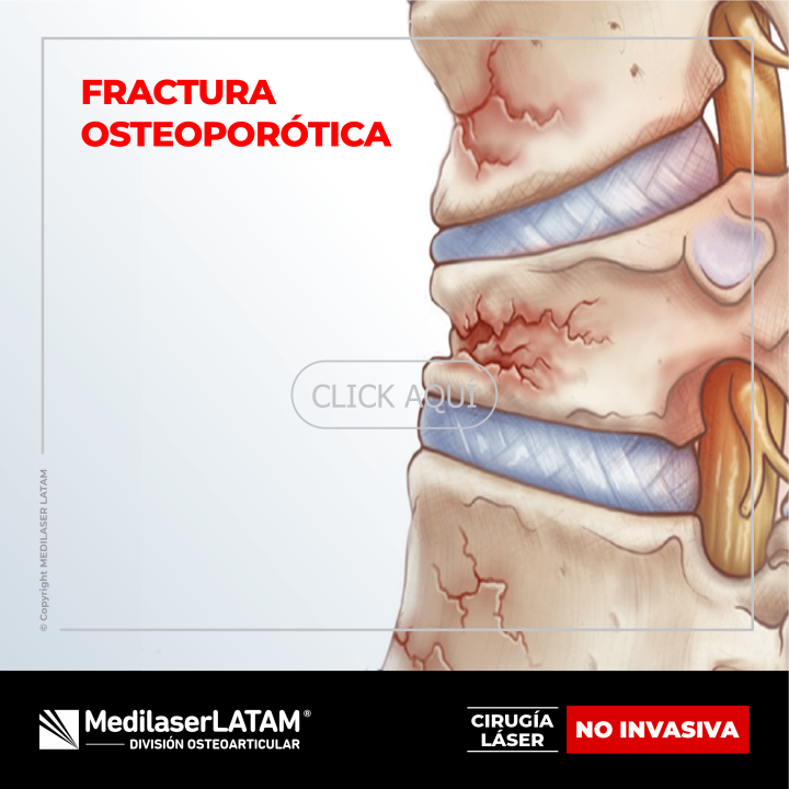 Fractura osteoporótica lumbar: tratamiento láser para consolidación ósea sin cirugía. 90% de efectividad comprobada.