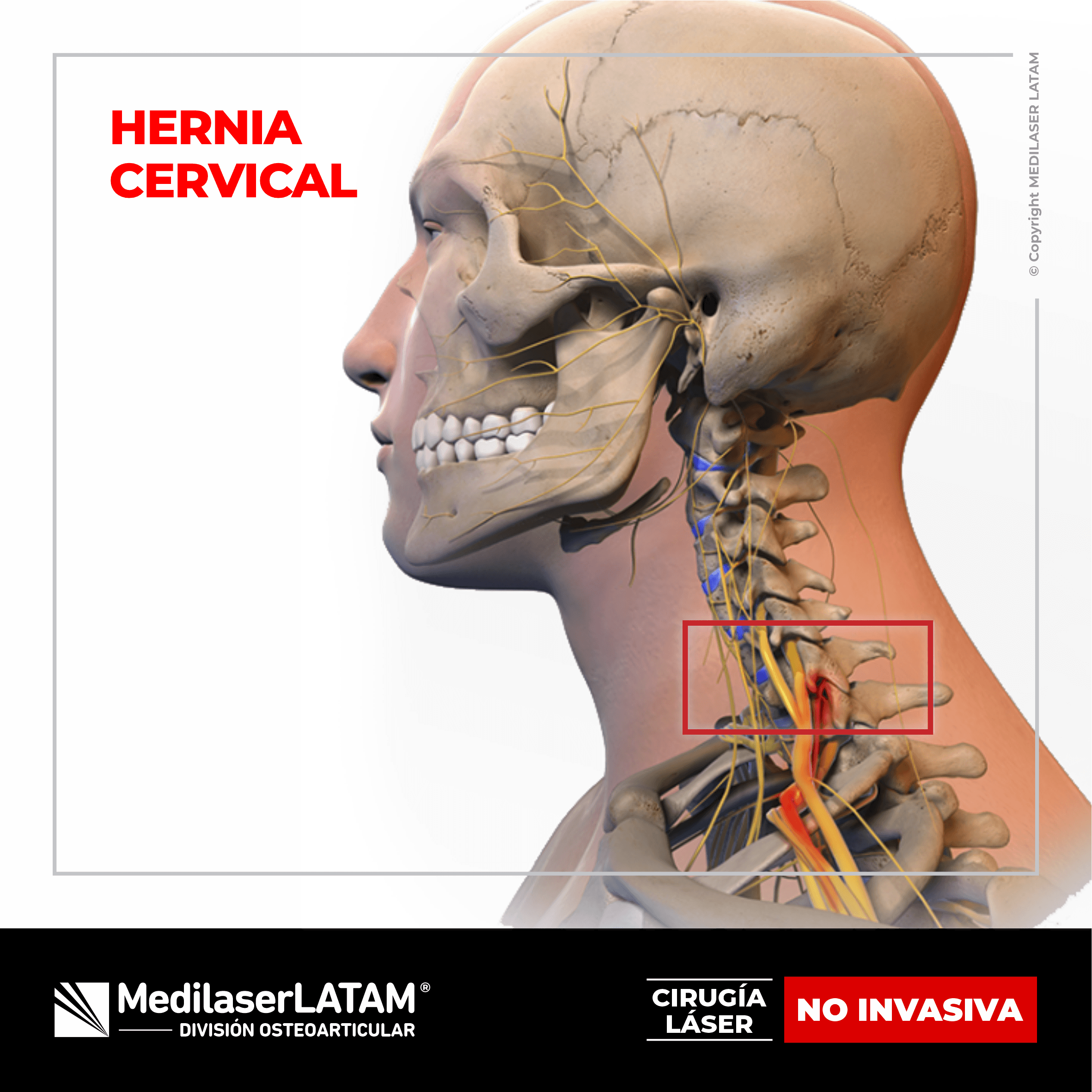 Hernia cervical: solución quirúrgica no invasiva para aliviar dolor, hormigueo y pérdida de fuerza. Técnica láser con 90% de efectividad.