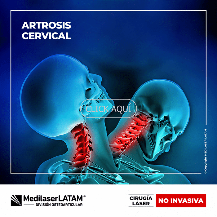 Artrosis cervical: tratamiento láser que alivia dolor y rigidez. Técnica con 12 años de investigación y 90% de efectividad