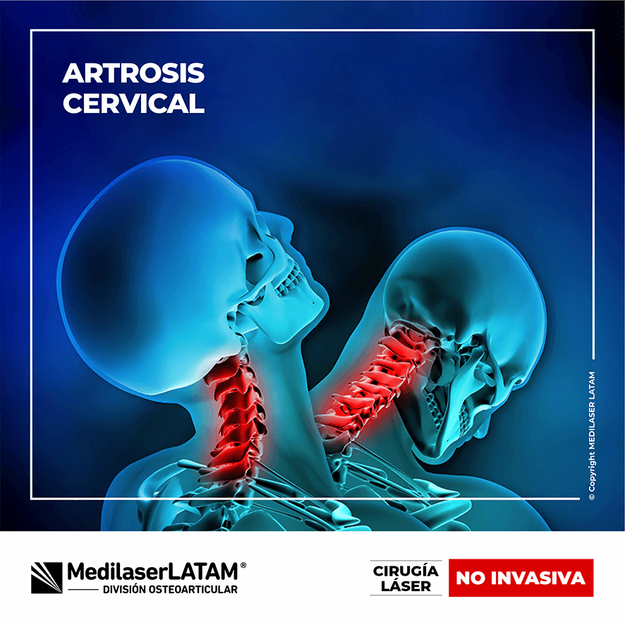 Artrosis cervical: tratamiento láser que alivia dolor y rigidez. Técnica con 12 años de investigación y 90% de efectividad