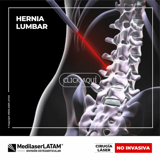 Hernia lumbar: Tratamiento con láser no invasivo en Medilaser LATAM. Alivia el dolor sin cirugía. 90% de efectividad comprobada.
