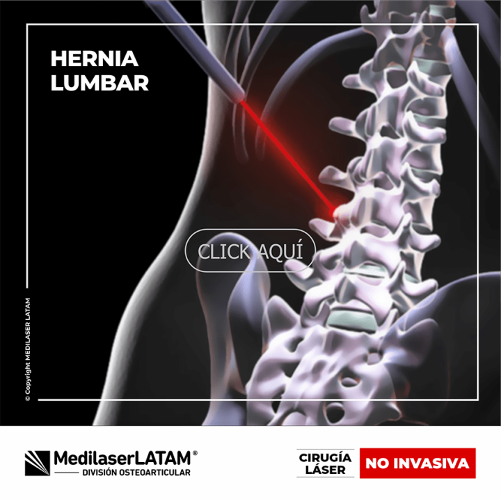 Hernia lumbar: Tratamiento con láser no invasivo en Medilaser LATAM. Alivia el dolor sin cirugía. 90% de efectividad comprobada.