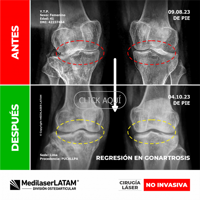 Evidencia de Regresión en Gonartrosis – Yaneth Talancha Secuencia TAC que prueba disminución de degeneración en rodilla derecha.