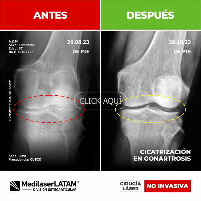 Evidencia en Cicatrización de Gonartrosis – Albertina Zuñiga Comparativo radiológico que demuestra reparación cartilaginosa en artrosis de rodilla.