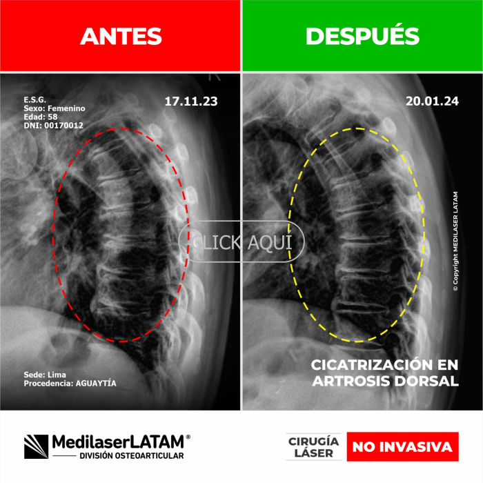 Evidencia en Artrosis Dorsal – Eufracia Sandoval Documentación radiológica que prueba reparación en vértebras dorsales. Resultados medibles.