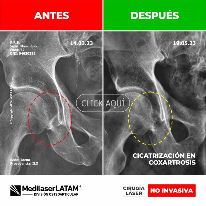 Evidencia en Coxartrosis – Pastor Rodríguez Estudio imagenológico con evolución de 6 meses mostrando regeneración articular en cadera.