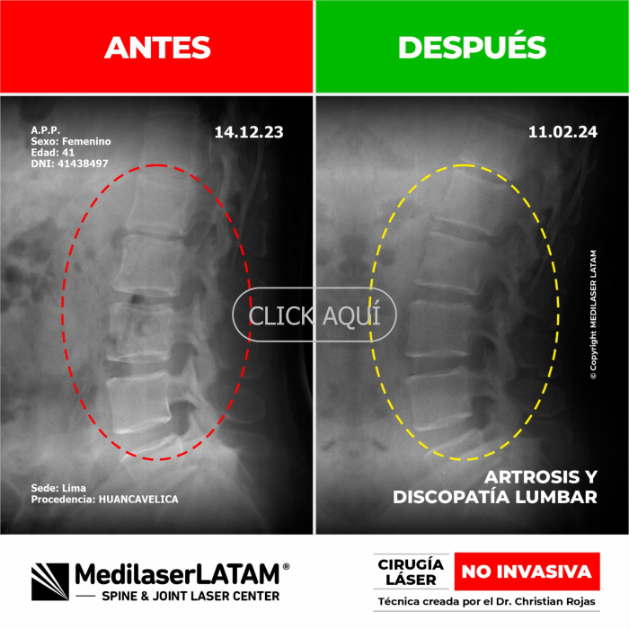 Evidencia en Artrosis y Discopatía Lumbar – Ana Palomino Radiografías seriadas que demuestran mejoría estructural en doble patología vertebral.