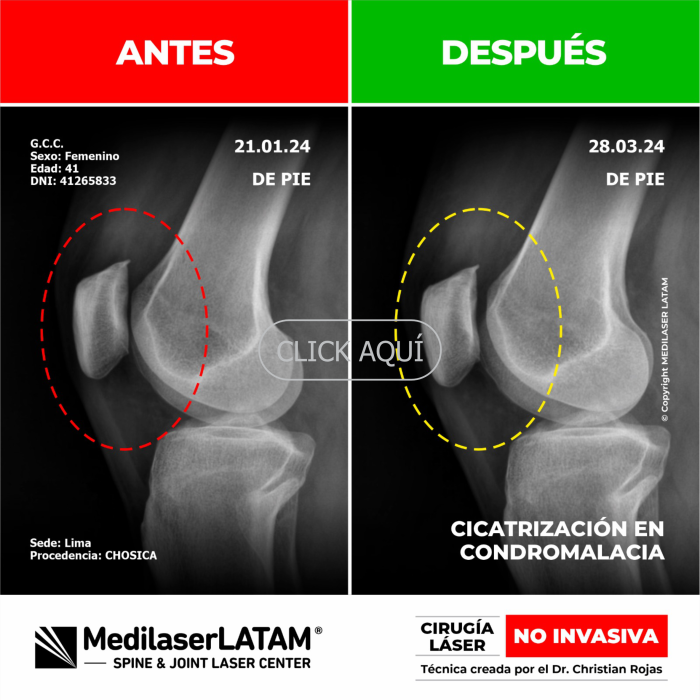 Evidencia en Condromalacia – Giovanna Capuñay Pruebas comparativas que evidencian recuperación del cartílago rotuliano. Caso real.