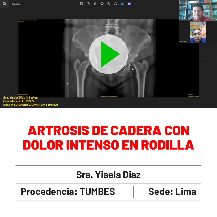 Testimonio de Ysela Díaz: Solución para artrosis de cadera con dolor irradiado a rodilla. Caso clínico real.