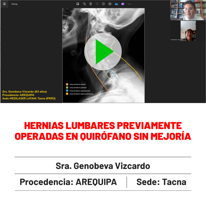 Testimonio de Genobeva Vizcardo: Hernias lumbares previamente operadas, ahora sin dolor. Seguimiento a 1 año.