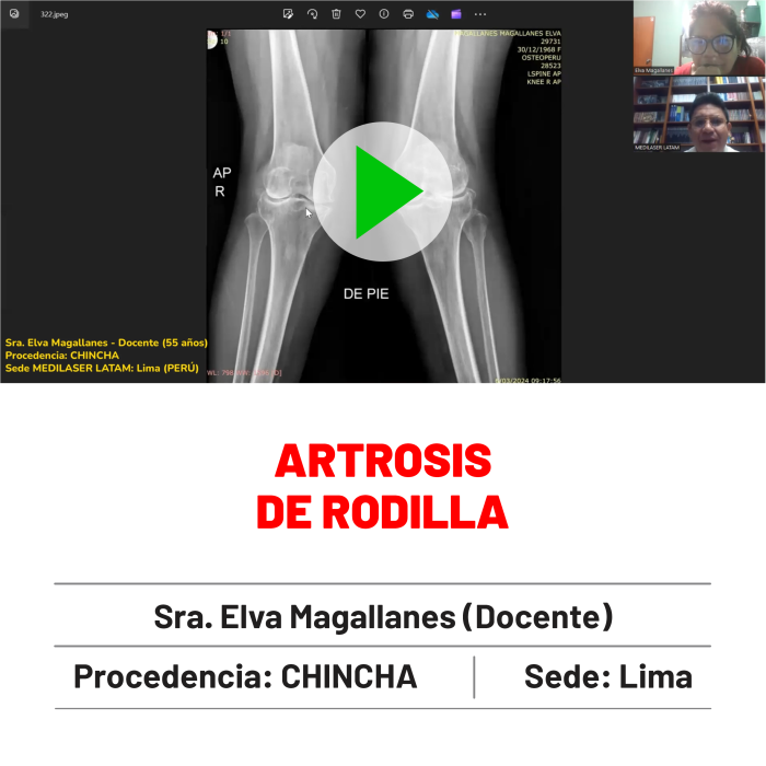 Testimonio de Elva Magallanes: Recuperación de artrosis de rodilla. Testimonio con evidencia radiológica.
