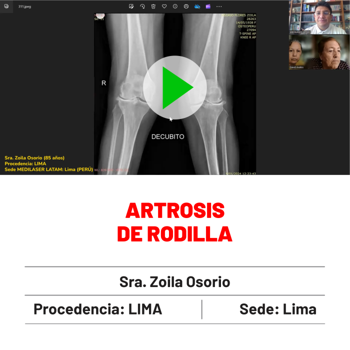 Testimonio de Zoila Osorio: Recuperación completa de artrosis de rodilla. Testimonio con seguimiento médico.