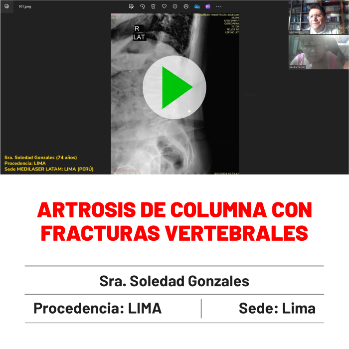 Testimonio de Soledad Gonzales: Artrosis de columna con fracturas vertebrales mejorada. Resultados reales.