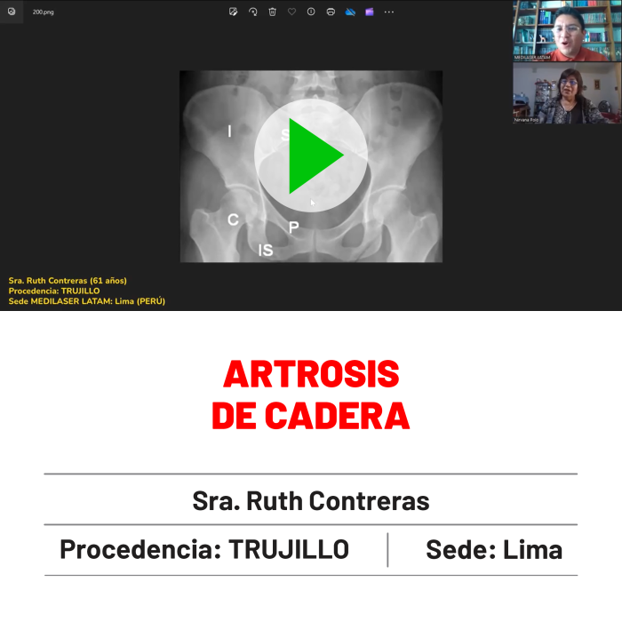 Testimonio de Ruth Contreras: Solución definitiva para artrosis de cadera con técnica láser mínimamente invasiva.
