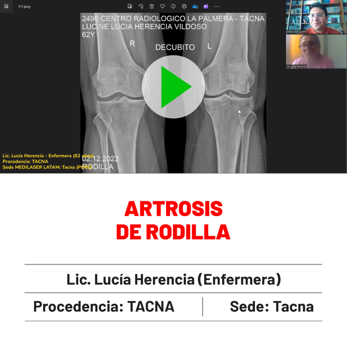 Testimonio de Lucía Herencia: Tratamiento exitoso para artrosis de rodilla con recuperación completa y sin dolor. Resultados verificados.