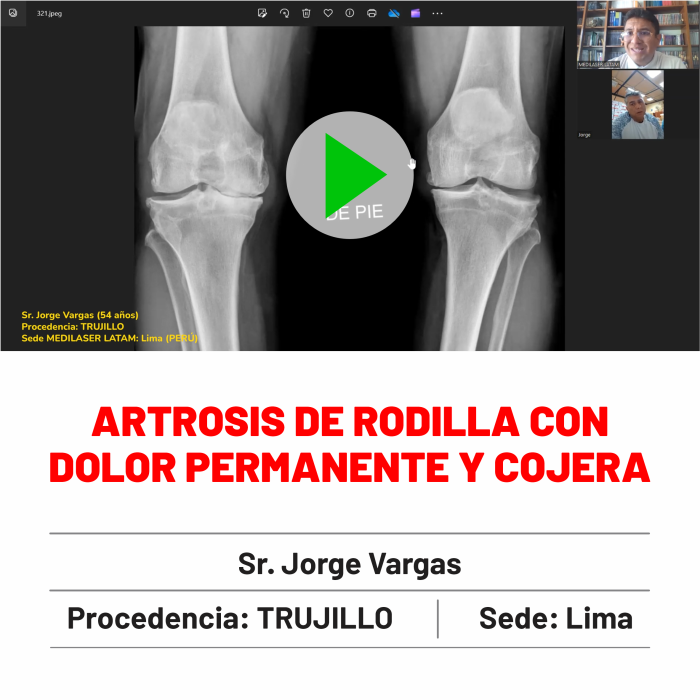 Testimonio de Jorge Vargas: Artrosis de rodilla con cojera y dolor permanente superados. Historia real con videos de evolución.