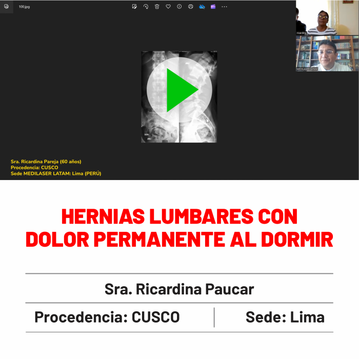 Testimonio de Ricardina Paucar: Hernias lumbares con dolor al dormir curadas. Testimonio con seguimiento a 6 meses.