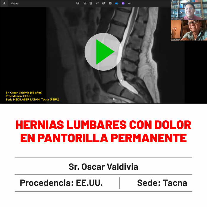 Testimonio de Óscar Valdivia: Hernias lumbares con dolor en pantorrilla resueltas. Experiencia real de recuperación sin cicatrices.
