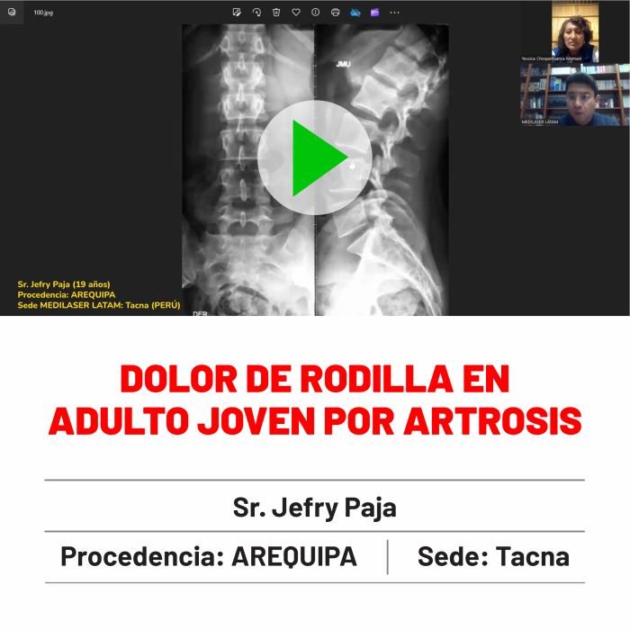 Testimonio de Jefry Paja: Dolor de rodilla en adulto joven por artrosis y meniscopatía resuelto.