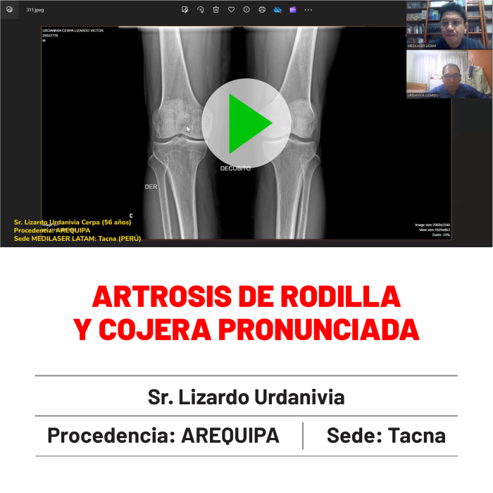 Testimonio de Lizardo Urdanivia: Superó artrosis de rodilla con cojera pronunciada. Resultados comprobados con videos.