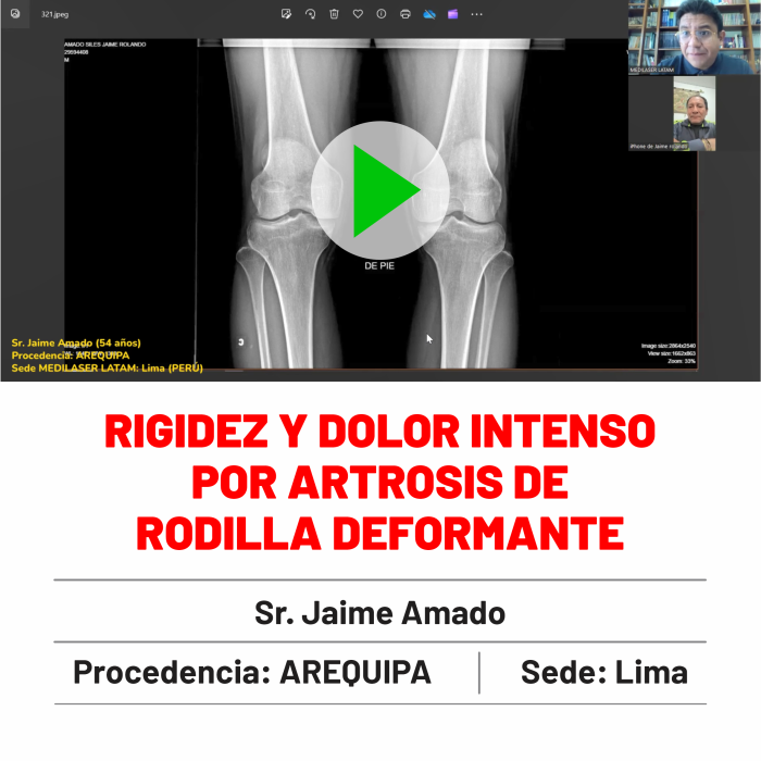 Testimonio de Jaime Amado: "Testimonio verificado: rigidez y dolor por artrosis deformante de rodilla eliminados en 3 semanas.