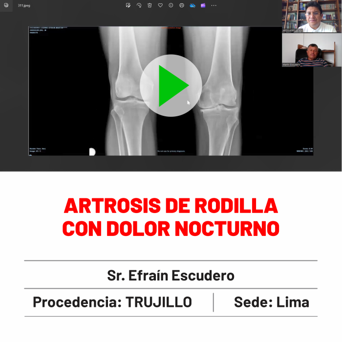 Testimonio de Efraín Escudero: Eliminación de dolor nocturno permanente por artrosis de rodilla. Testimonio real.