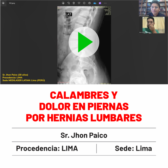 Testimonio de Jhon Paico: Alivio permanente de calambres y dolor en piernas causados por hernias lumbares. Caso documentado.