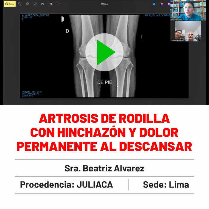 Testimonio de Beatriz Álvarez: "Solución definitiva para artrosis de rodilla con hinchazón y dolor al reposo. Recuperé mi calidad de vida sin cirugía abierta.