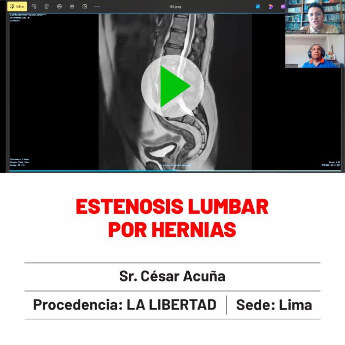 Testimonio de César Acuña: Cirugía láser para estenosis lumbar por hernias discales. Alivio del dolor y recuperación con técnica no invasiva.