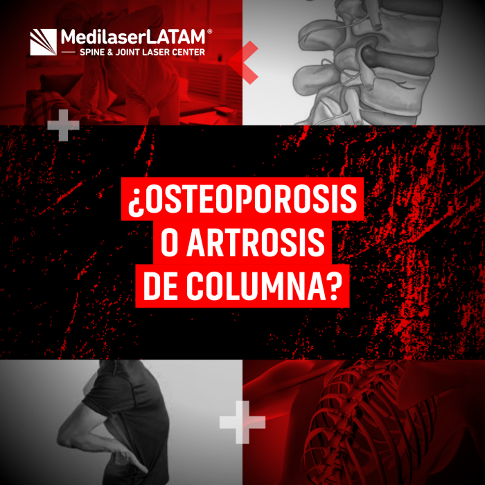 Dolor de columna: ¿es osteoporosis o artrosis? Aprende a diferenciarlos y tratamientos efectivos para cada caso. Diagnóstico preciso.