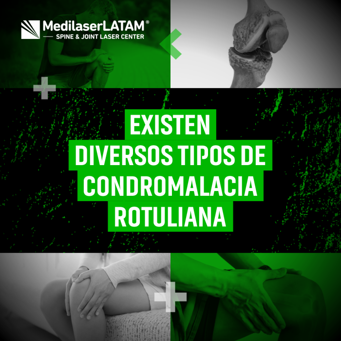 Condromalacia rotuliana: grados y tratamientos según tu caso. Terapias con láser y ejercicios para regenerar cartílago.