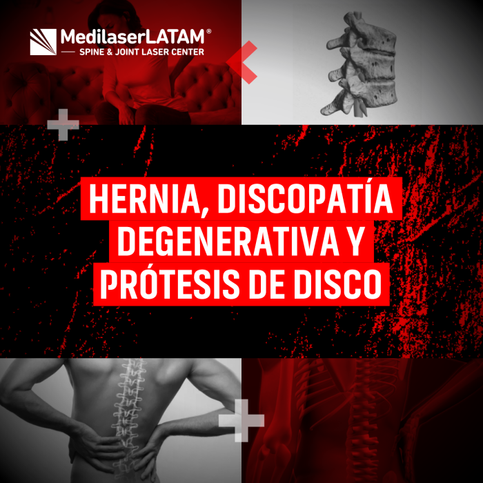Hernias discales y discopatía: ¿cuándo optar por prótesis? Alternativas no quirúrgicas con tecnología láser.